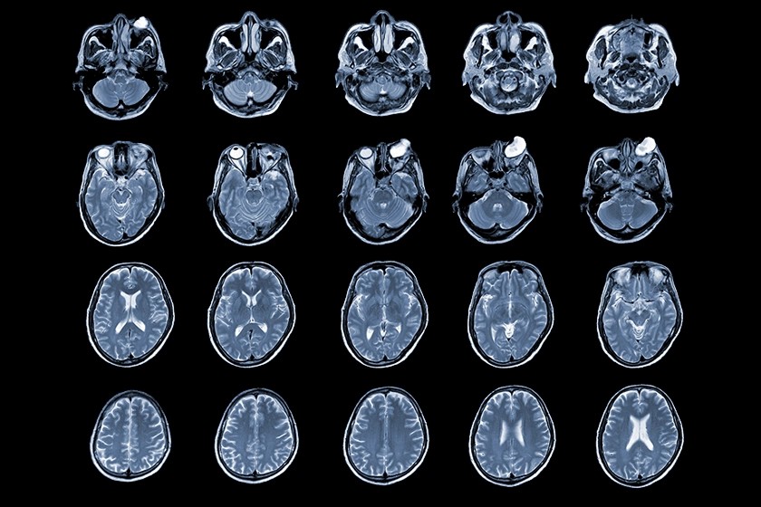 Brain MRI